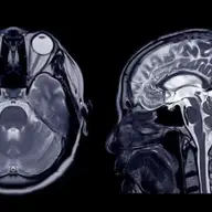RMN orbite - o investigație imagistică valoroasă în patologia orbitală