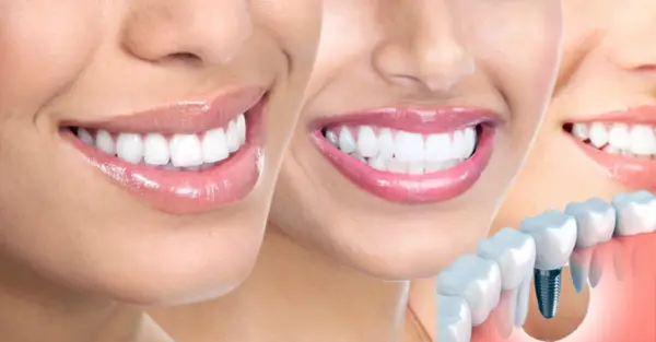 Implantul dentar: Cand este recomandat si ce trebuie sa avem in vedere?