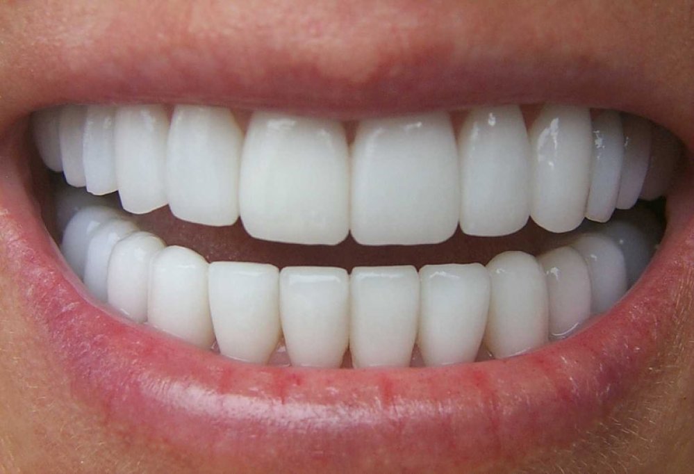 Avantajele si dezavantajele coroanelor dentare din zirconiu