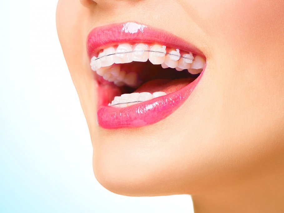 Aparatul dentar - Motive pentru care sa il porti atunci cand situatia impune acest lucru