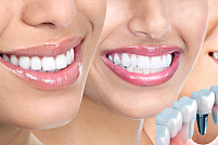 Implantul dentar: Cand este recomandat si ce trebuie sa avem in vedere?