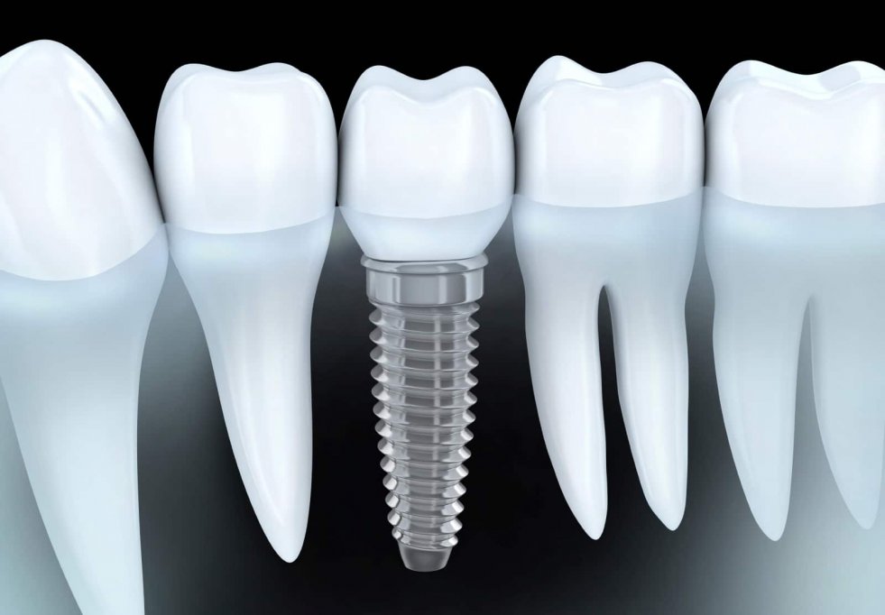 Ce trebuie sa stii despre un implant dentar si ce beneficii iti aduce?
