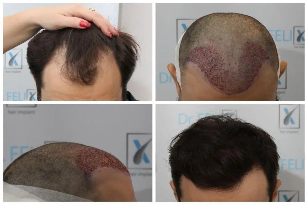 Află despre implantul de păr și de ce ai dori să îți faci această intervenție