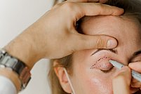 Pleoape căzute? Află când este indicată blefaroplastia